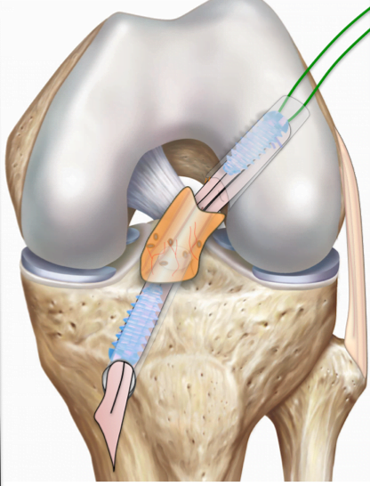 all acl knee 2