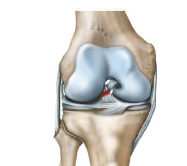 ACL Injury - torn ACL